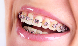 Types of Braces in Sugar land and Houston TX